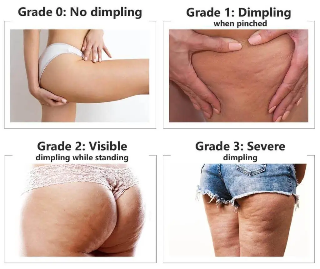 Representation of the stages of cellulite development Walton on the Hill